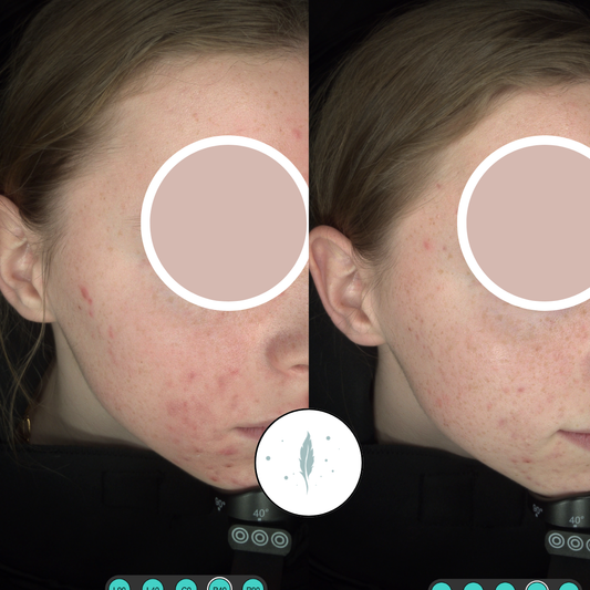 Three Acne Myths Debunked