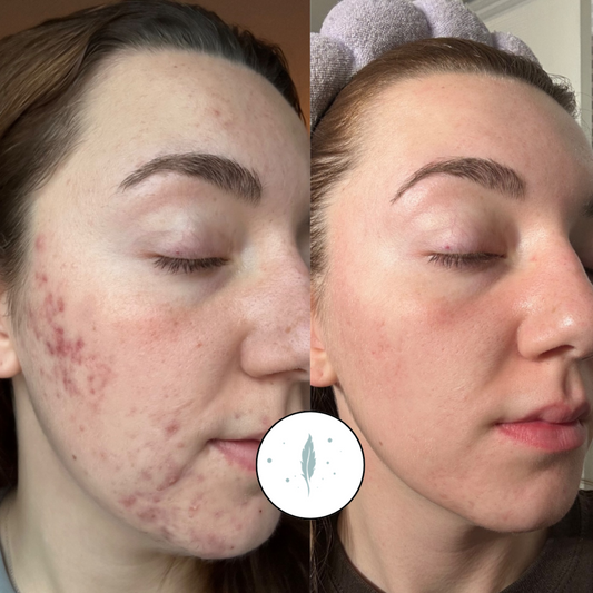 What actually happens when I join the Acne Blueprint Program?