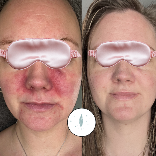 Can You Get Acne Help Without Living in Port Stanley?