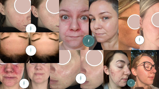 How to Clear Acne in 3 Steps (Sorry... It's Not Going to Happen Overnight)